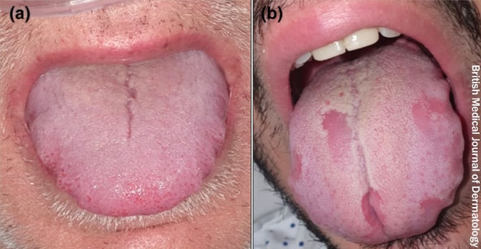So what does COVID tongue look like? Your tongue may start to appear white and patchy Patients have also reported an unusually dry mouth and subsequent fungal infection. It could also be accompanied by a change to the tongue's sensation & pain during chewing2/n