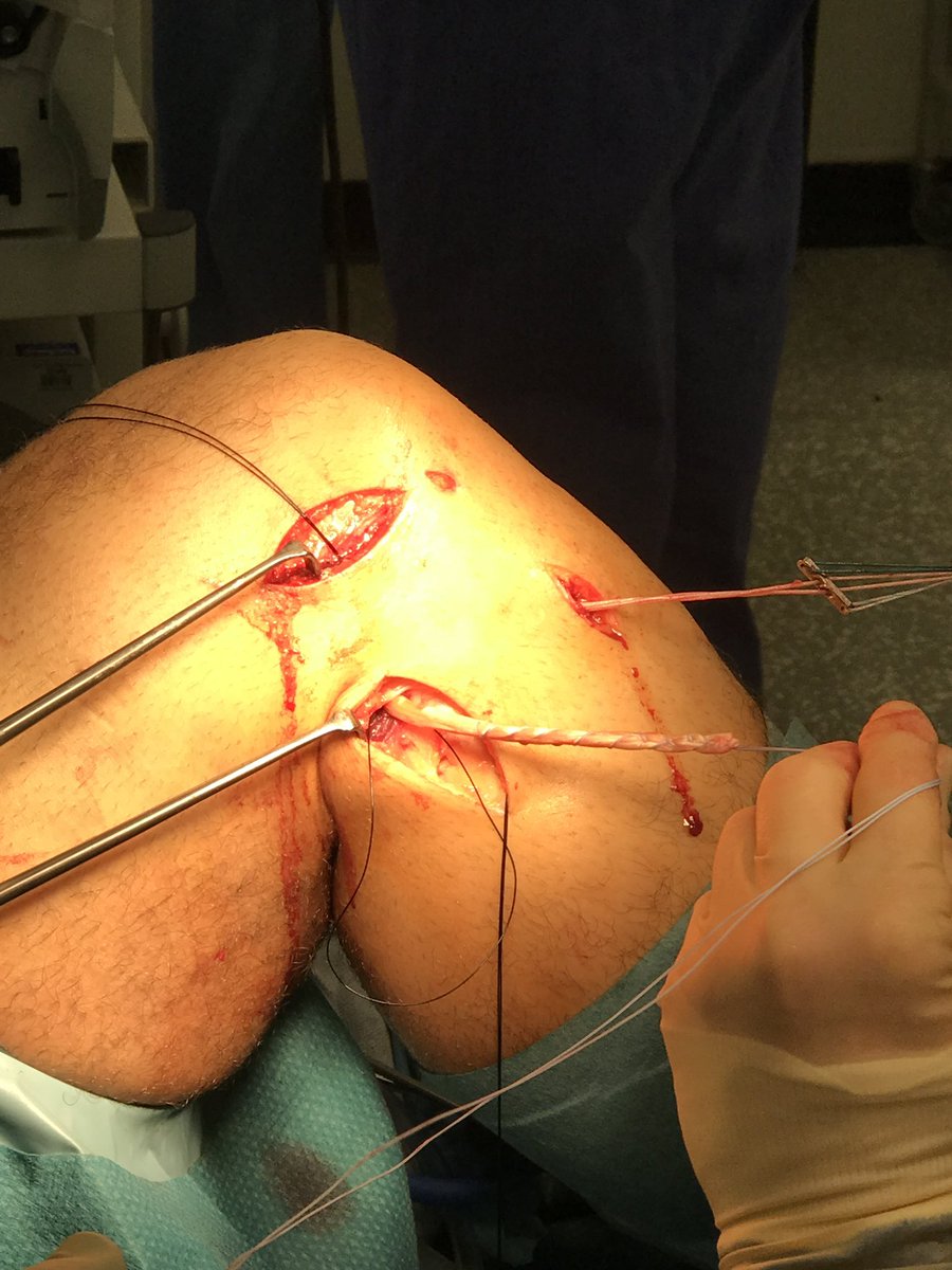 kneedoc74's tweet photo. ACL &amp; PLC/LCL reconstruction at LTHT elective unit. Modification of LaPrade method using femoral aperture fixation (2 sockets), fibula tunnel and a Pull-Up XL to tension the ST graft in the tibial tunnel. #ligamentsurgery #aclsurgery #lclsurgery #multiligamentsurgery https://t.co/2Ym5dPabs8