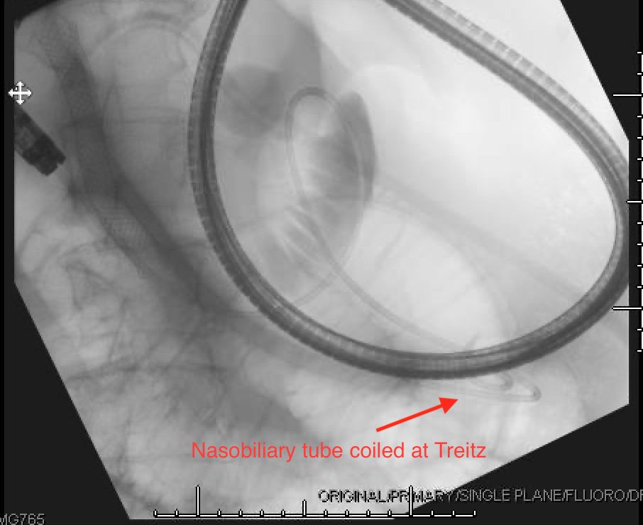 4/9Place the pigtail of your naso-biliary drain at the ligament of Treitz This is your ideal puncture site to maximize your window for deep insertion of LAMS catheter (which will minimize AEs)Connect NB drain to water pump and infuse saline, contrast, and methylene blue