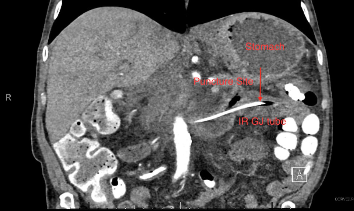 3/9Study pre-procedural imaging carefully You want to see a distended stomach with D3/D4 coursing immediately inferior to and adjacent to gastric bodyIn this CT slice, the IR placed GJ tube is a nice guide as to how D3/D4 courses in relation to the stomach