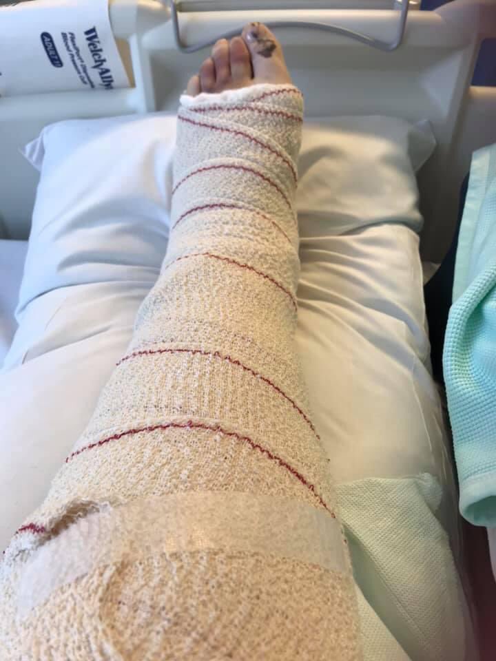 Life2On's tweet image. Getting bored with the broken ankle now. Three weeks done, six to go...
#greenlanes #trailriding #bikeaccident #brokenankle #platedandpinned