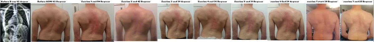 Still a work in progress... 7 sessions of the non-surgical ASMI for #Scoliosis 
I might be a few degrees out but, ball-park, it's not too far off I think