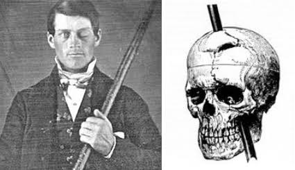 SaberespoderE's tweet image. Una barra de 5 kilos de peso, más de un metro de largo y 2,5 cm de grosor atravesó la cabeza de Phineas Gage.Entró por su mejilla izquierda y salió por la parte superior del cráneo.Sobrevivió,pero su carácter cambió radicalmente pues se volvió mal hablado cuando antes era tímido.