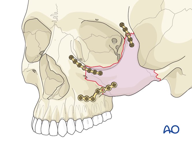 Dr_Espino's tweet photo. El tratamiento es quirúrgico. Puede ser difícil elegir si realizar fijación de 1, 2, 3 o 4 puntos, y depende de la fractura y de la experiencia del cirujano. La #AoReference recomienda estas fijaciones..
#SaundersVsCanelo #Saunders #CirugíaPlástica #CirujanoPlásticoCertificado https://t.co/3qIkmz2tMy
