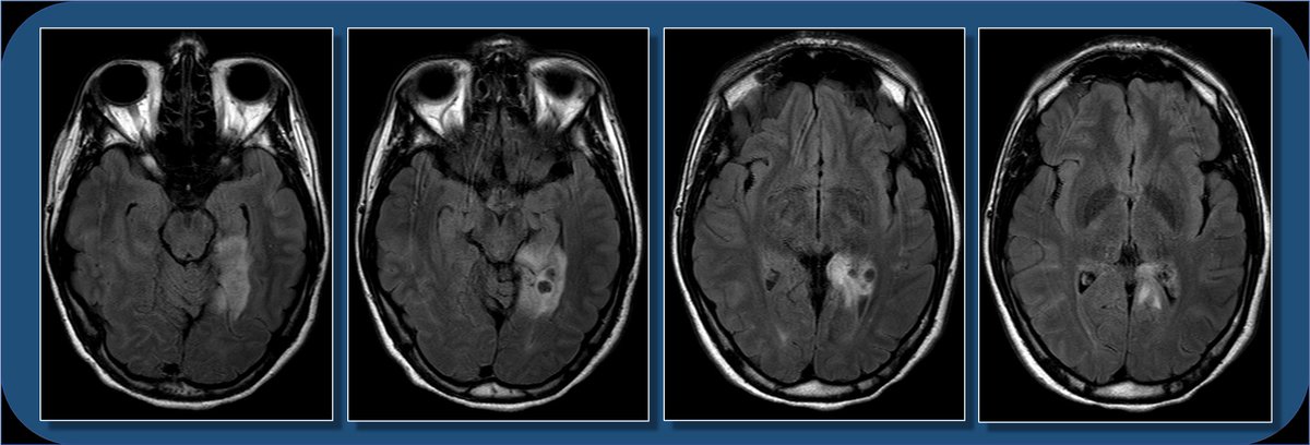 18yoF with seizures. The FLAIR images show focal cortical expansion with cystic components, suggesting a cortically based tumor.1/13 #radres  #MEDstudents  #neurorad  #neuroanatomy  #meded  #medtwitter  #FOAMed  #FOAMrad  #radiology  #neurology  #neurosurgery