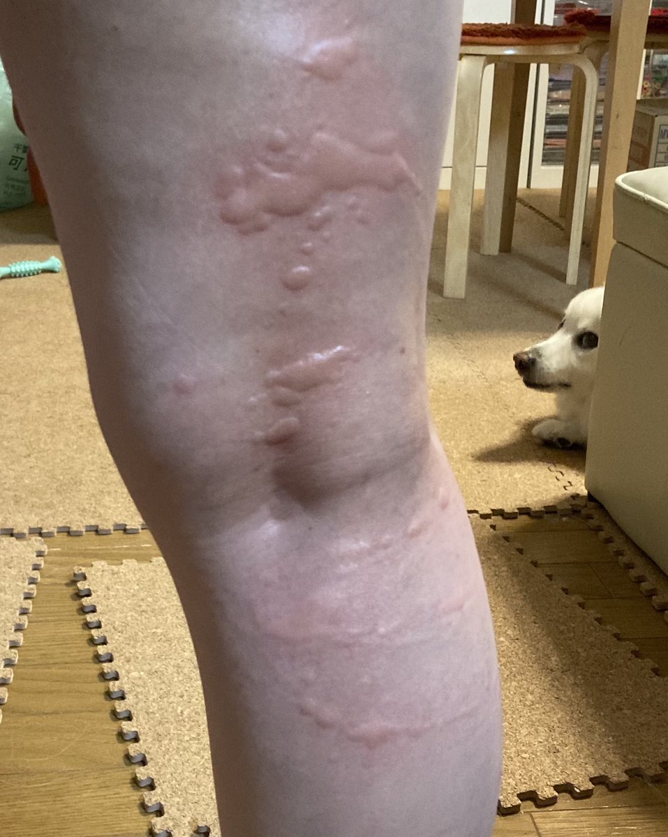 鹿間そよ子 漫画とかでの蕁麻疹て鳥肌みたいなぶつぶつの表現 コリン性蕁麻疹ってやつ がほとんどだったから まさかこんな蚊に 噛まれたみたいなプックリが蕁麻疹だと思わなかった