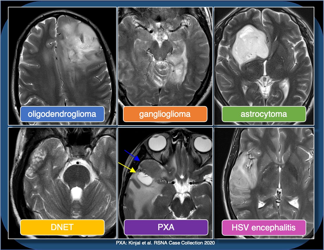 Ddx for cortically based tumors in child/young adult includes oligodendroglioma (usually middle-aged adults, often with Ca++), DNET (bubbly, uncommon enhancement), PXA (prominent nodular enhancement), and astrocytoma (usually low grade). Encephalitis can also look similar. 3/13