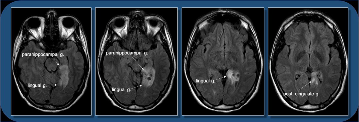 This location can be a bit difficult to describe if you aren’t up on gyral anatomy. Is it med temporal lobe? occipital lobe? limbic? Describing gyral location is more precise, can explain expected symptoms, and clue in future surgical approach.5/13