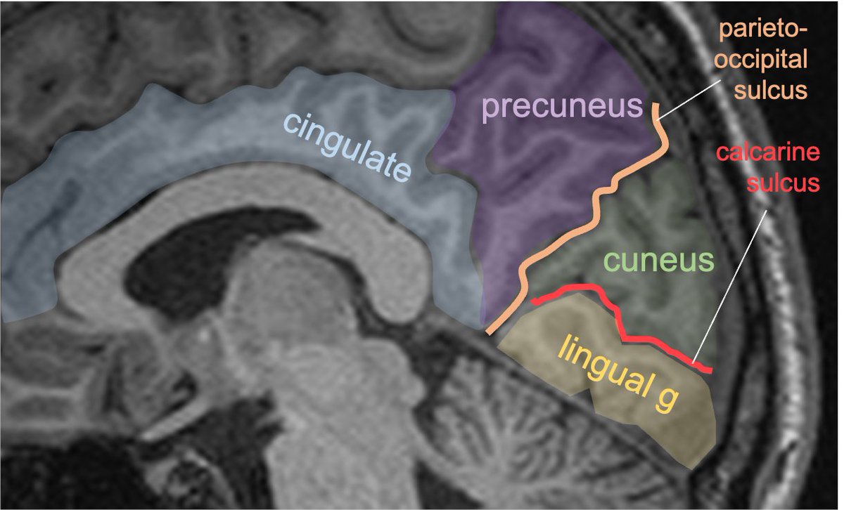 Gyral anatomy of the medial brain surface: calcarine sulcus divides the cuneus from lingual gyrus at the med occ lobe. The lingual g continues anteriorly along the med/ inferior temporal lobe. The cingulate g wraps sup & posterior to corpus callosum along the medial brain.7/13
