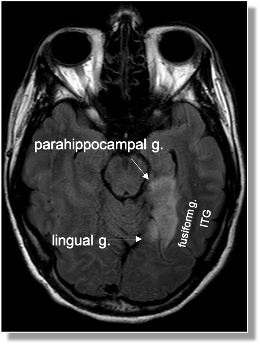 The lingual gyrus is involved in holistic visual and word processing, encoding visual memories, imagery, and dreaming. The ganglioglioma in the shown case is centered in the lingual gyrus.8/13