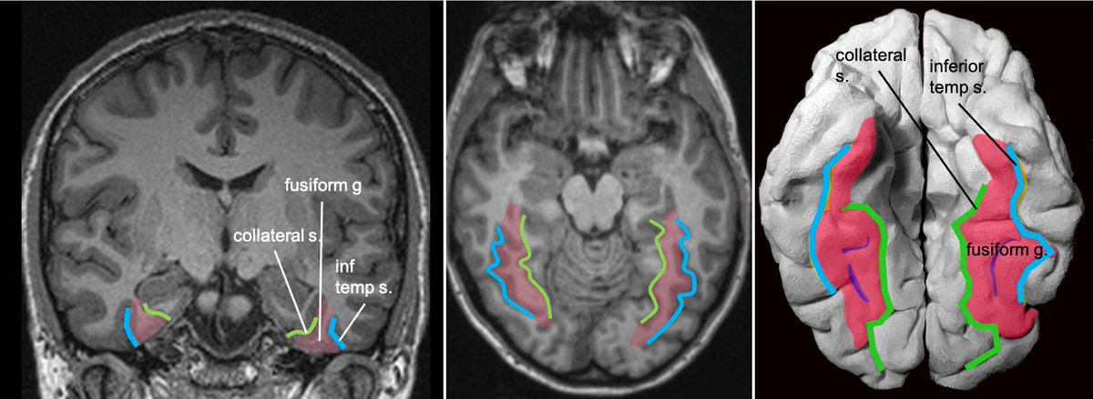 Fusiform g is just lateral to lingual g on the inf surface of temporal lobe, separated by collateral sulcus. It's medial to the ITG, separated by ITS. Involved in face and body recognition; word form recognition (on left). (Fusiform g was not definitively involved by tumor). 9/13