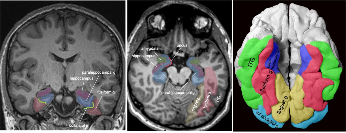 Parahippocampal g. is anterior continuation of lingual g. Part of Limbic System. Important in memory encoding and retrieval, visual and social contextualizing. 10/13