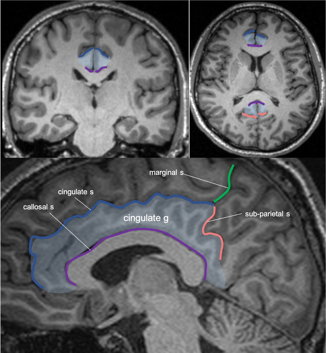 Cingulate g. is part of the limbic circuit; the post cingulate cortex (PCC) is important in default mode network, awareness, pain, and episodic memory retrieval. PCC including the retrosplenial cortex (which together some call restrosplenial gyrus) is involved by the tumor. 11/13