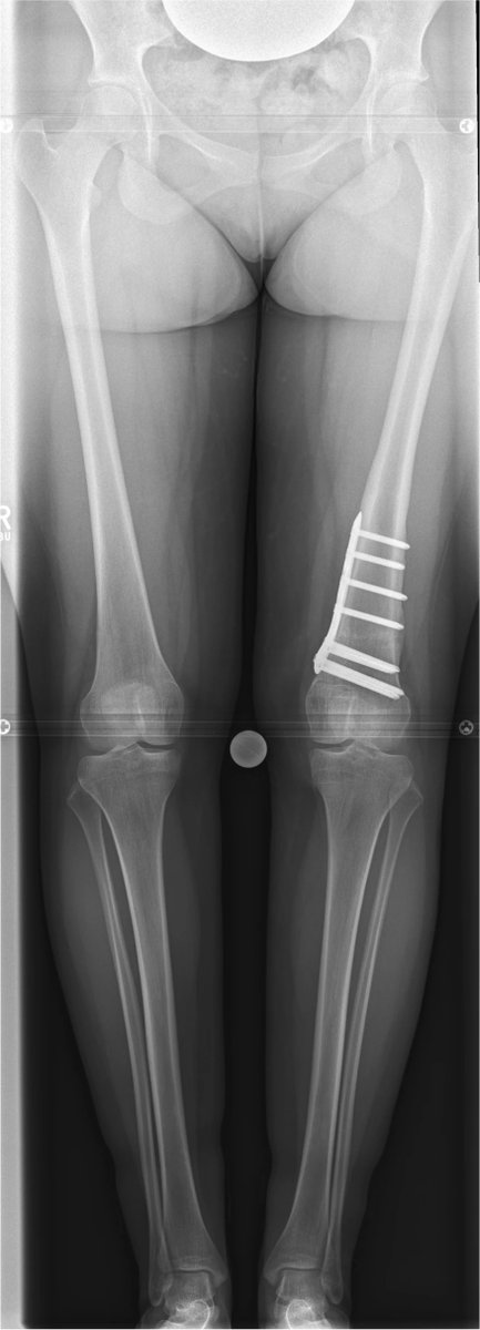 Supracondylar external rotation osteotomy of the femur is used sucessfully  to correct femoral antetorsion.
This new paper by Konrads et al. shows that it has implications along all the lower limb that should be taken into account.
Read the full text at: rdcu.be/ckgG0