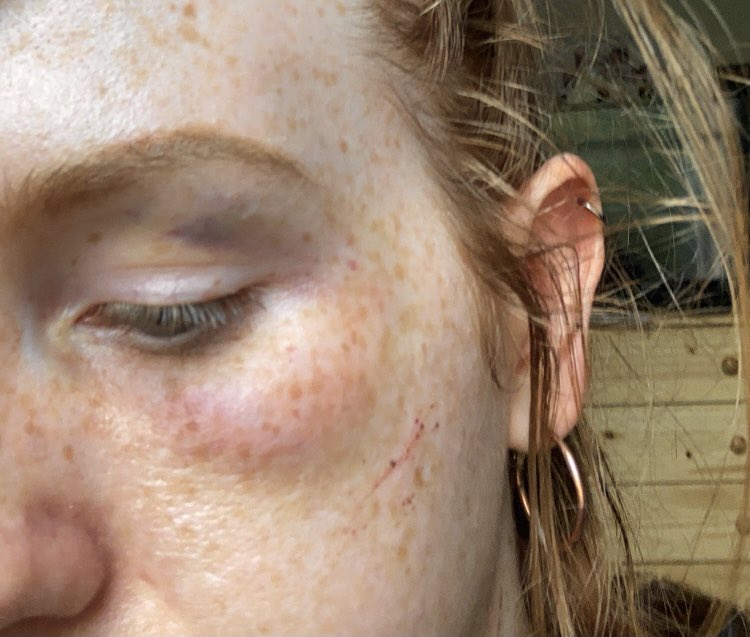 cxitlan's tweet photo. On Tuesday night I was attacked by three men when I went on a run.

I should be able to go out at night without the threat of being assaulted.

People should feel safe no matter what time . Things need to change. https://t.co/wmyqD7ccbV