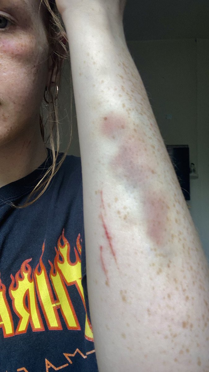 cxitlan's tweet photo. On Tuesday night I was attacked by three men when I went on a run.

I should be able to go out at night without the threat of being assaulted.

People should feel safe no matter what time . Things need to change. https://t.co/wmyqD7ccbV