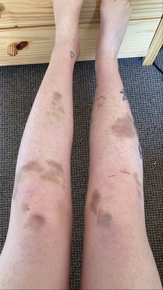 On Tuesday night I was attacked by three men when I went on a run.

I should be able to go out at night without the threat of being assaulted.

People should feel safe no matter what time . Things need to change.