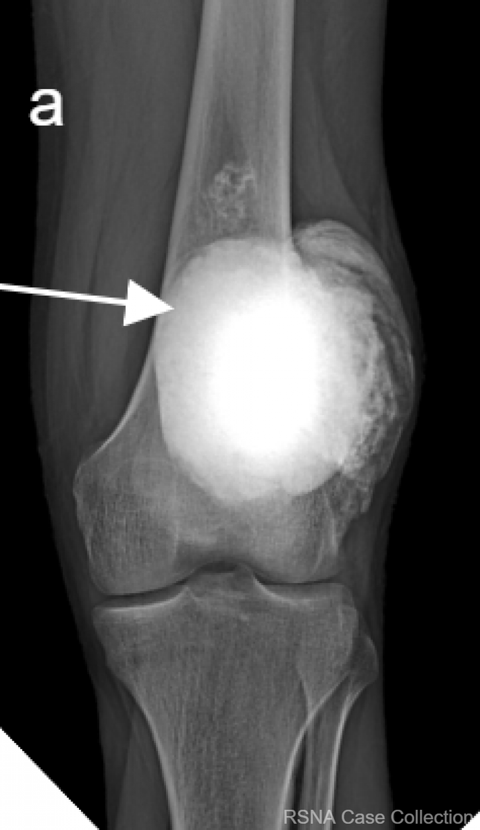 RCC_Editor's tweet photo. Make no “bones” about it- the diagnosis for this #RSNACC COW is Parosteal Osteosarcoma!! https://t.co/MgiJxpb9im 

Thanks @RSNA #RSNACC #MSKRad Deputy Ed Dr Kumaravel @MKMSKER @UTRadRes &amp; authors Drs Richard-Edwards, Sood and Ncube @VisheshSood88 @ivncube83 Groote Schuur Hospital https://t.co/oAgOMmyRKI