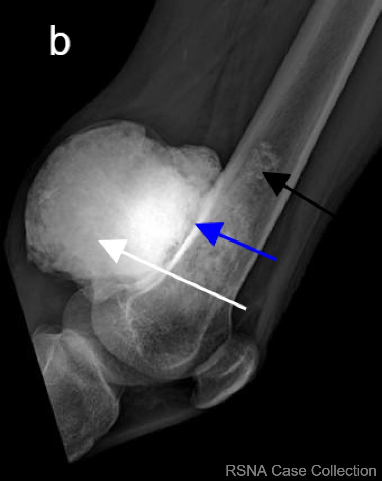 RCC_Editor's tweet photo. Make no “bones” about it- the diagnosis for this #RSNACC COW is Parosteal Osteosarcoma!! https://t.co/MgiJxpb9im 

Thanks @RSNA #RSNACC #MSKRad Deputy Ed Dr Kumaravel @MKMSKER @UTRadRes &amp; authors Drs Richard-Edwards, Sood and Ncube @VisheshSood88 @ivncube83 Groote Schuur Hospital https://t.co/oAgOMmyRKI