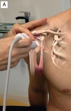 MskRoom1's tweet photo. Awaiting the release of our Msk Ultrasound book, here is another appetizer:
Evaluation of the rotator interval in the transverse axis.
If you want to be notified when the book is available, please register at:
https://t.co/dh6QuzL4ly https://t.co/IHCbkIaL6O