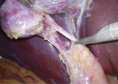 The Critical View of Safety (CVS) in Laparoscopic Cholecystectomy

Bile duct injuries:
CVS+ 👉 0.3%
CVS- 👉 1.0%
CVS? 👉 2.3%

Complications:
CVS+ 👉 4.8%
CVS- 👉 7.9%
CVS? 👉 9.9%

authors.elsevier.com/c/1d1zS,V2cW4N… @hpbjournal @terho_petra #SoMe4HPB