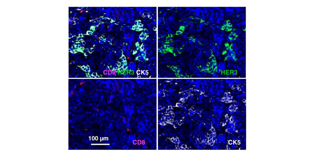 Led by <a href="/SilvioGutkind/">GutkindLab</a>, <a href="/UCSDCRCERA/">UCSD Health Moores Cancer Center CRCERA</a> scientists employed an unbiased kinome-wide siRNA screen to reveal that HER3, was essential for the proliferation of most head and neck squamous cell carcinoma cells that did not harbor PIK3CA mutations.

<a href="/NatureComms/">Nature Communications</a>:
go.nature.com/32RWIpg