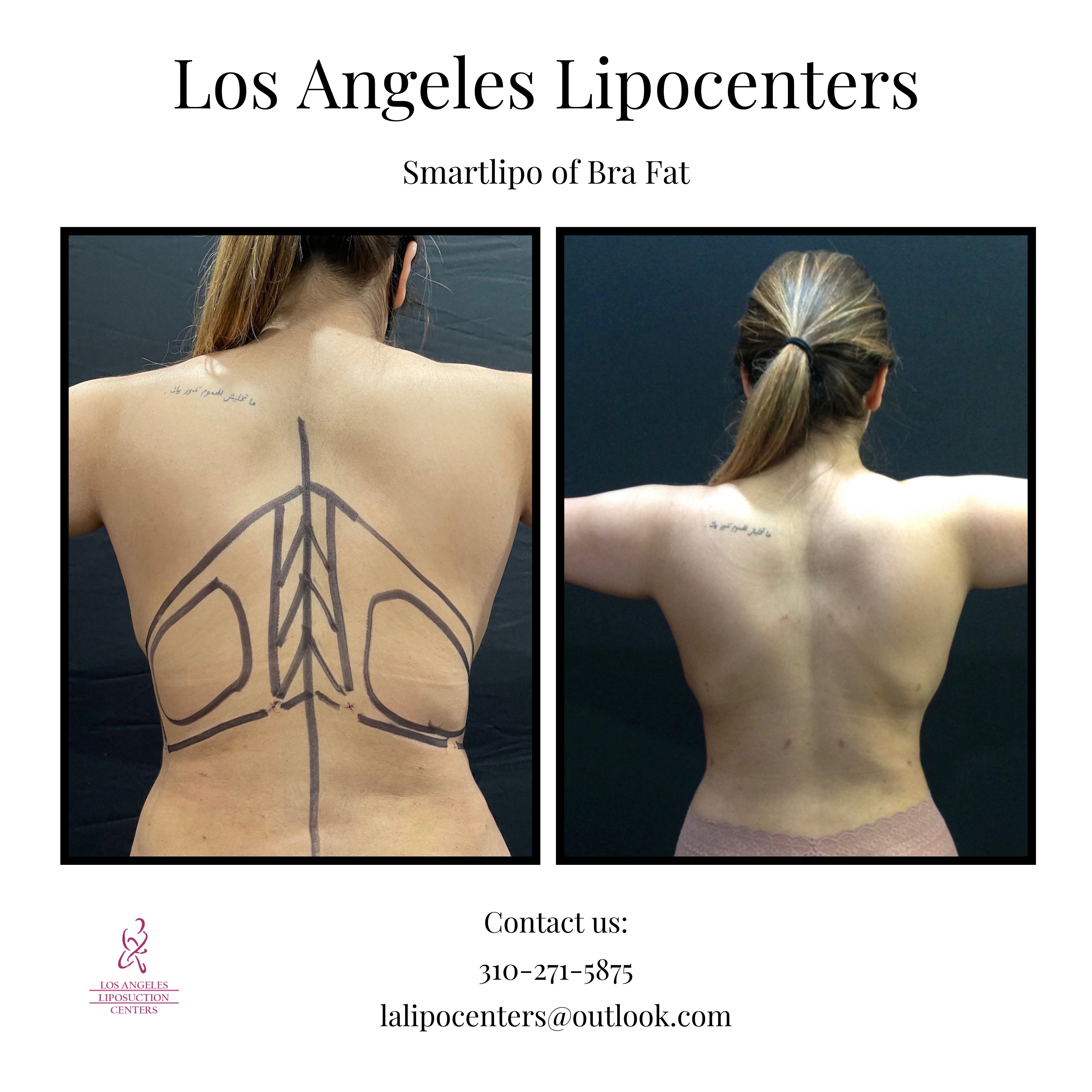 Los Angeles Liposuction Centers on X: Female patient had