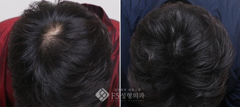 f5_scalp's tweet image. F5頭皮クリニック | 30代男性・つむじハゲ・メディカルSMPの症例
⇒ameblo.jp/f5scalp/entry-…

#頭皮クリニック #F5整形外科 #脱毛 #薄毛 #メディカルSMP #抜け毛 #プロペシア #アボダート #ビオチン #頭頂部 #植毛 #ヘアタトゥー