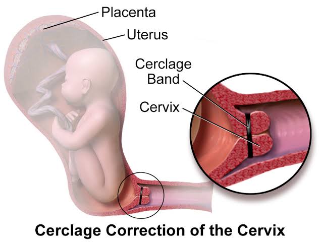 childbirth. So anything that makes it open before then especially in the second trimester might lead to miscarriage.When it opens like that, we call it "Cervical Weakness" and to correct it we had to tie the cervix to make sure it remains closed till term, a procedure called...