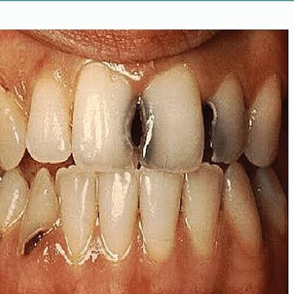 LibraryNurses's tweet photo. Dental caries 
https://t.co/xS7FDKCv2V https://t.co/VvjLEeHf1r