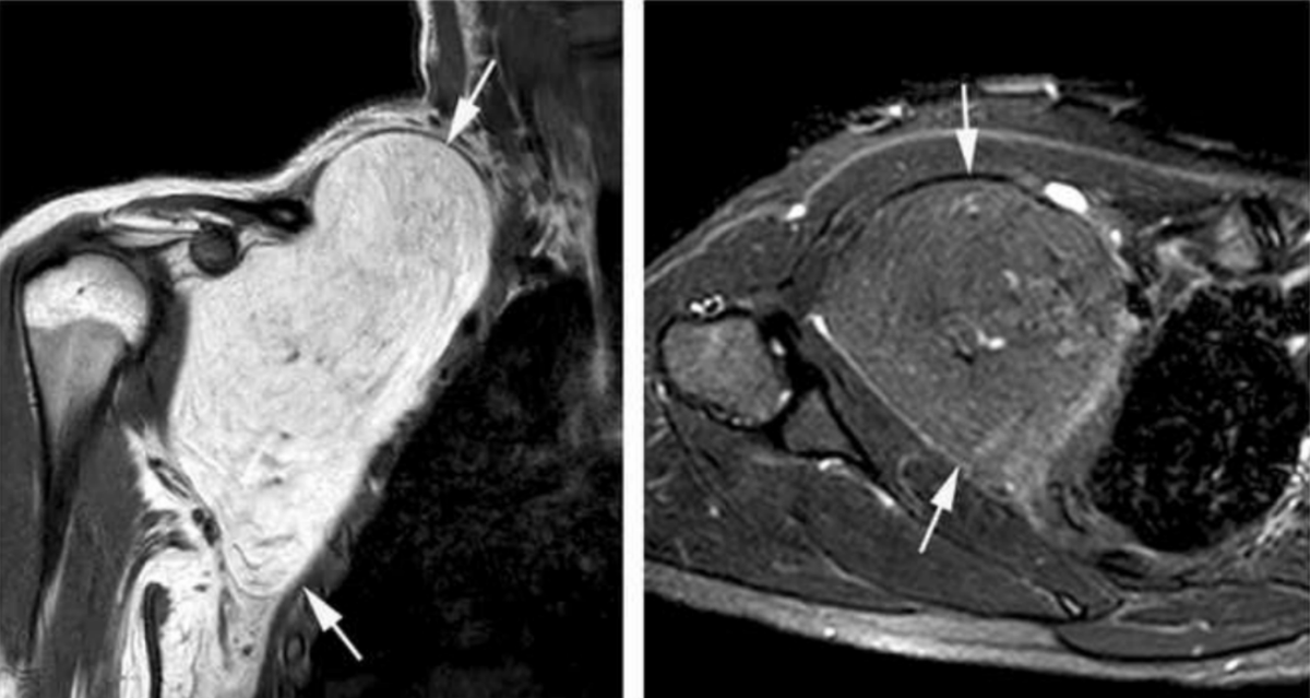 BIR Journals (@bjr_radiology) on Twitter photo The incidence and relevance of Non-Fatty components in trunk and extremity lipomatous soft tissue masses
bit.ly/3eG9vkn
<a href="/rupert_berkeley/">Rupert Berkeley</a> #Radiology The incidence and relevance of Non-Fatty components in trunk and extremity lipomatous soft tissue masses
bit.ly/3eG9vkn
<a href="/rupert_berkeley/">Rupert Berkeley</a> #Radiology