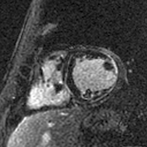 The lateral wall involvement spares the most subendocardial portion and/or the papillary muscles and trabeculations, indicating it is subepicardial (unlike a transmural MI that started subendocardially and involves the papillary muscles/trabeculations).