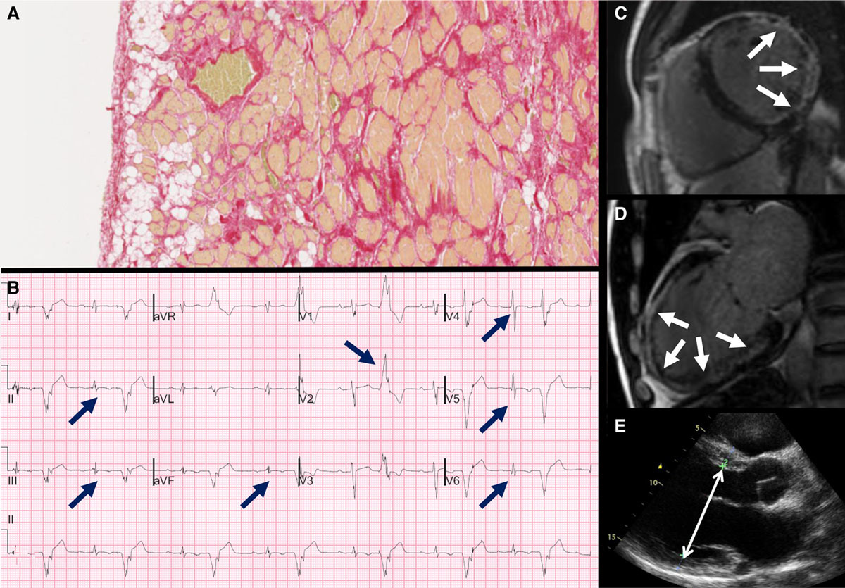 This pattern has been shown in ACM in pathology studies such as these: https://www.ahajournals.org/doi/10.1161/CIRCULATIONAHA.118.037230 https://pubmed.ncbi.nlm.nih.gov/19465822/ 