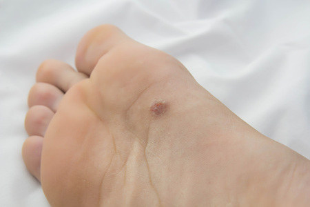 What Are Skin Cancers of the Feet? bit.ly/3dQqSQg #DrTimBarry #FootCare