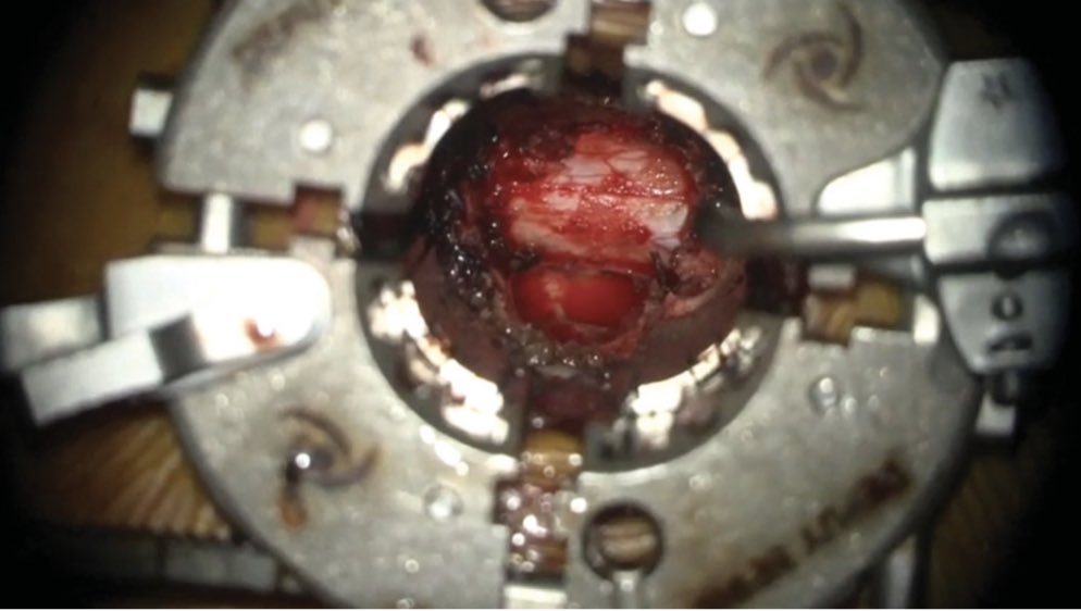 Featured this month, #ONSNew video @NeurosurgeryCNS: Minimally Invasive Tubular Separation Surgery for Metastatic Spinal Cord Compression. Check it out! @CNS_Update academic.oup.com/ons/article-ab…