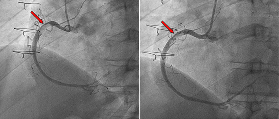 How should I treat residual large right coronary thrombus in a recent-healed #COVID19 patient with #STEMI? 

View the treatment options retained by the authors as well as the opinion of a different team 😷🩺! <a href="/deharo_pierre/">pierredeharo</a> <a href="/SpychajC/">Spychaj Jean-Charles</a>  <a href="/IllescasEdgar/">Edgar Illescas</a>

ow.ly/bwxy30rG3ss