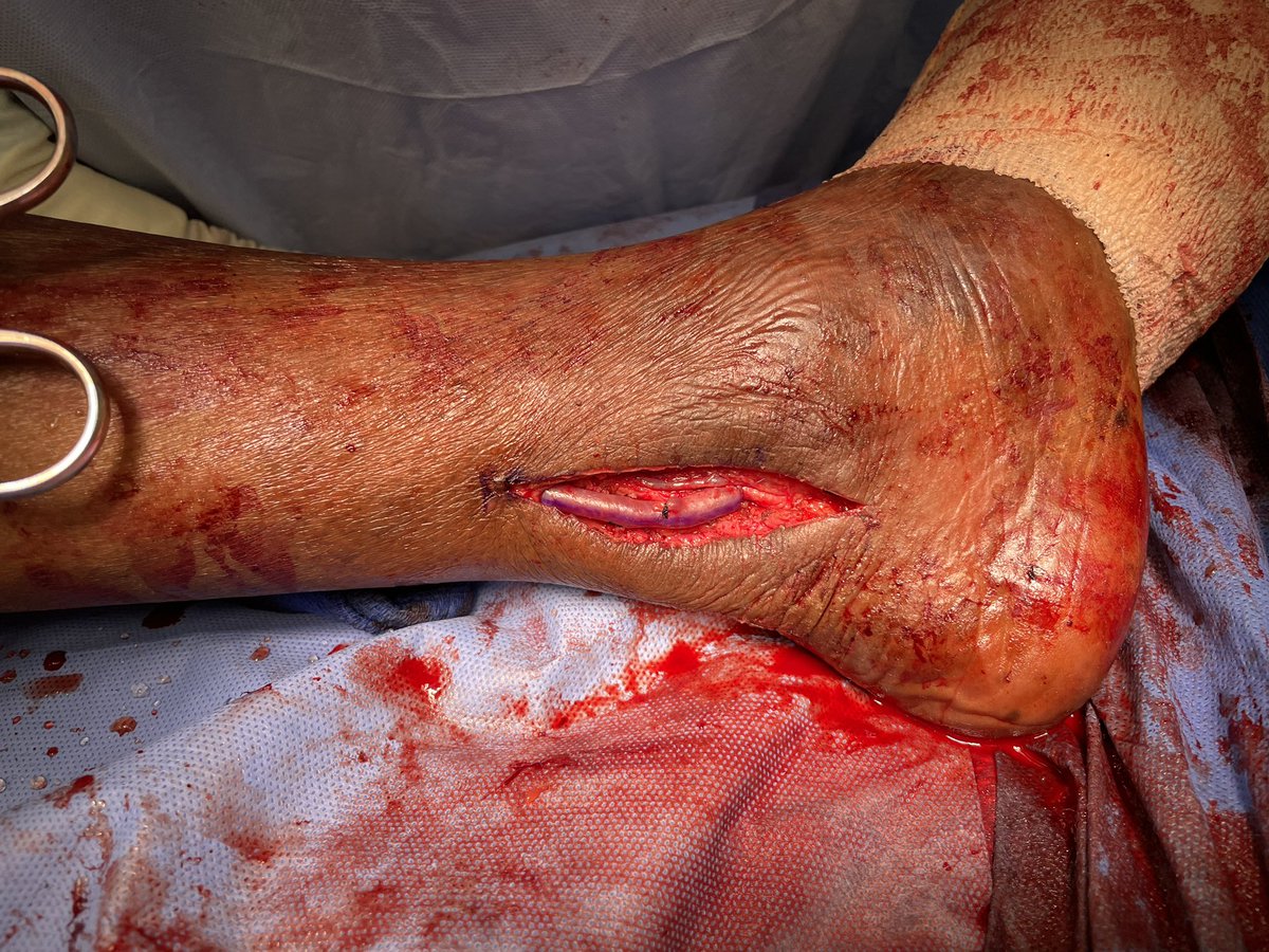 While I’m aggressive with #endovascular interventions and #pedal access in some cases, other times young patients are best served with old fashioned #VascularSurgery - bypass with autologous #SaphenousVein from above-knee popliteal #artery to posterior tibial artery at the ankle.