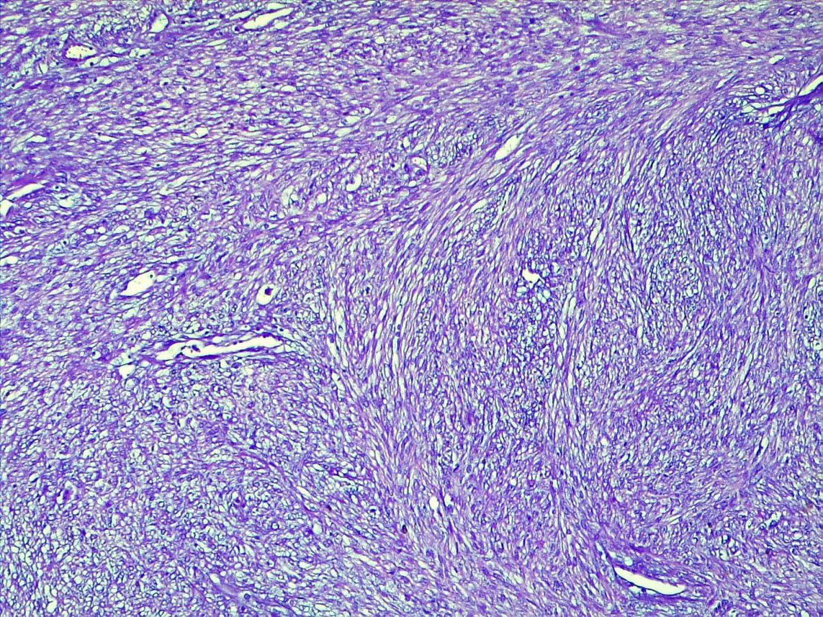 71y M with testicular tumor #pathology #Pathologist #GUTpath @slusagar @D4L14H