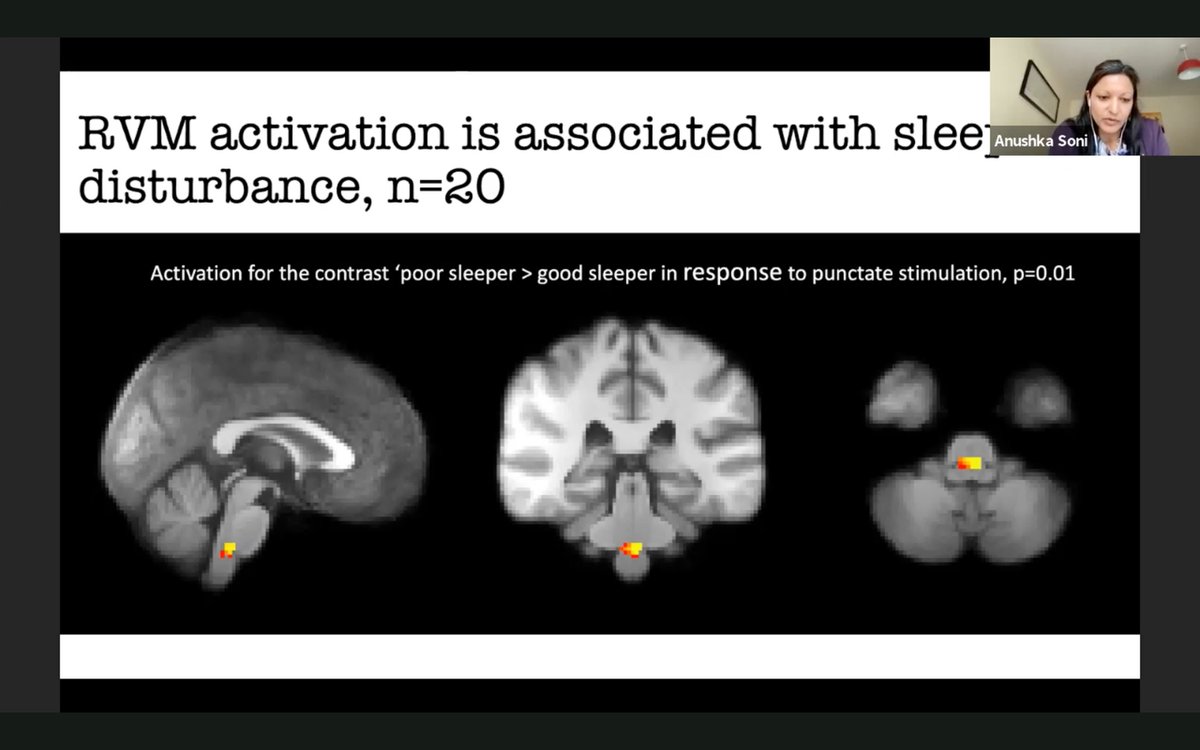 draleiva's tweet image. Excellent presentation by Dr Anushka Soni in the poster session in #BPSASM2021 on Psychological mediators and neural correlates of sleep disturbance in osteoarthritic knee pain