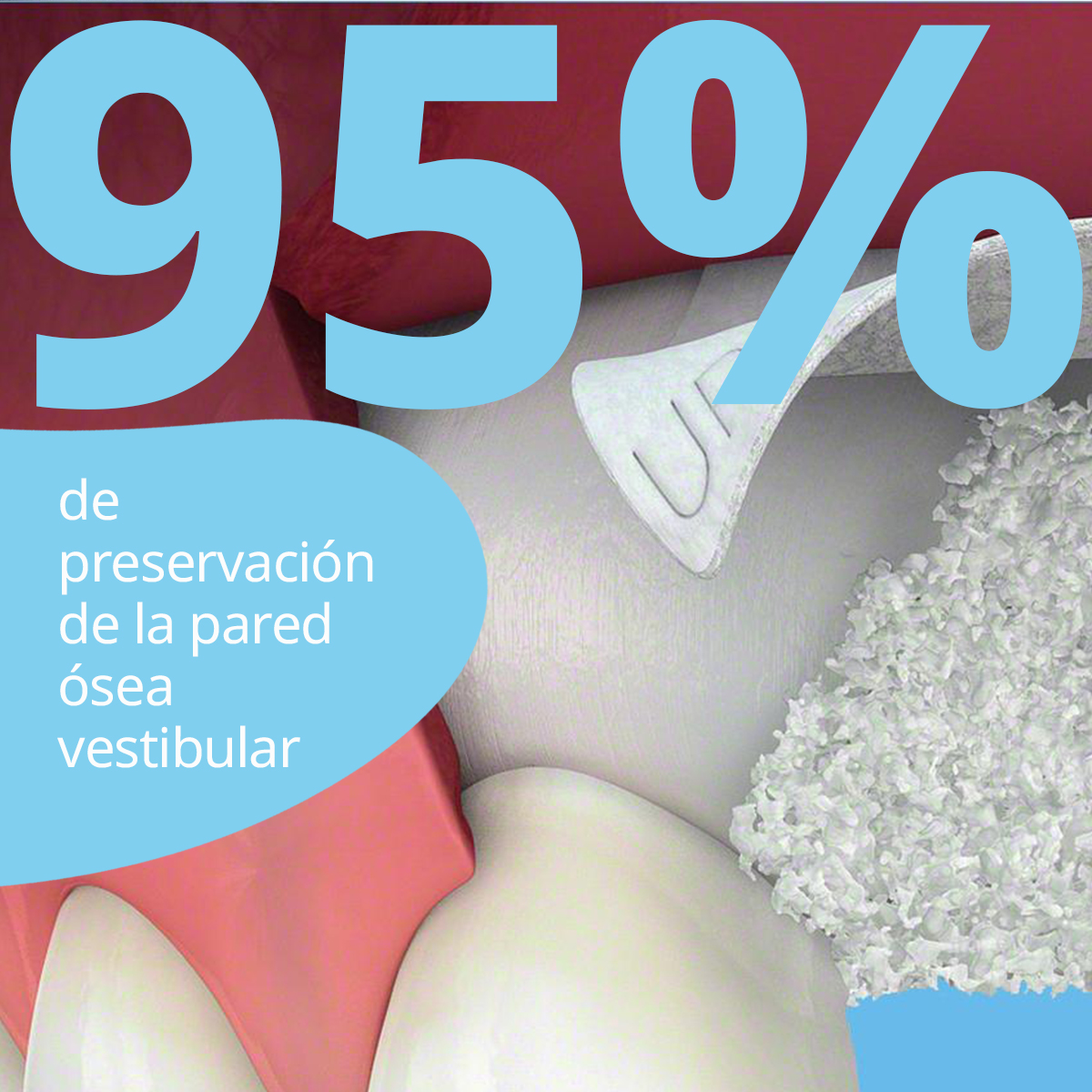 Según varios estudios, la regeneración ósea con Geistlich Bio-Gide® permite, con el aumento del contorno, preservar la pared ósea vestibular en el 95% de los casos en un periodo de 5 a 9 años.
No te la juegues.😉
Fuentes: Buser D et al., J Dent Res. 2013 Dec;92(12 Suppl):176S–82S
