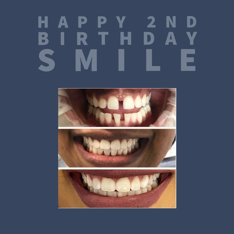 2 year review of this composite bonding make-over, and it’s still looking stunning!

Our Nurse Firdose has a secret passion for composite material technology, so from her research she sources some fabulous materials that  polish into a glass-like glaze optimising their longevity.