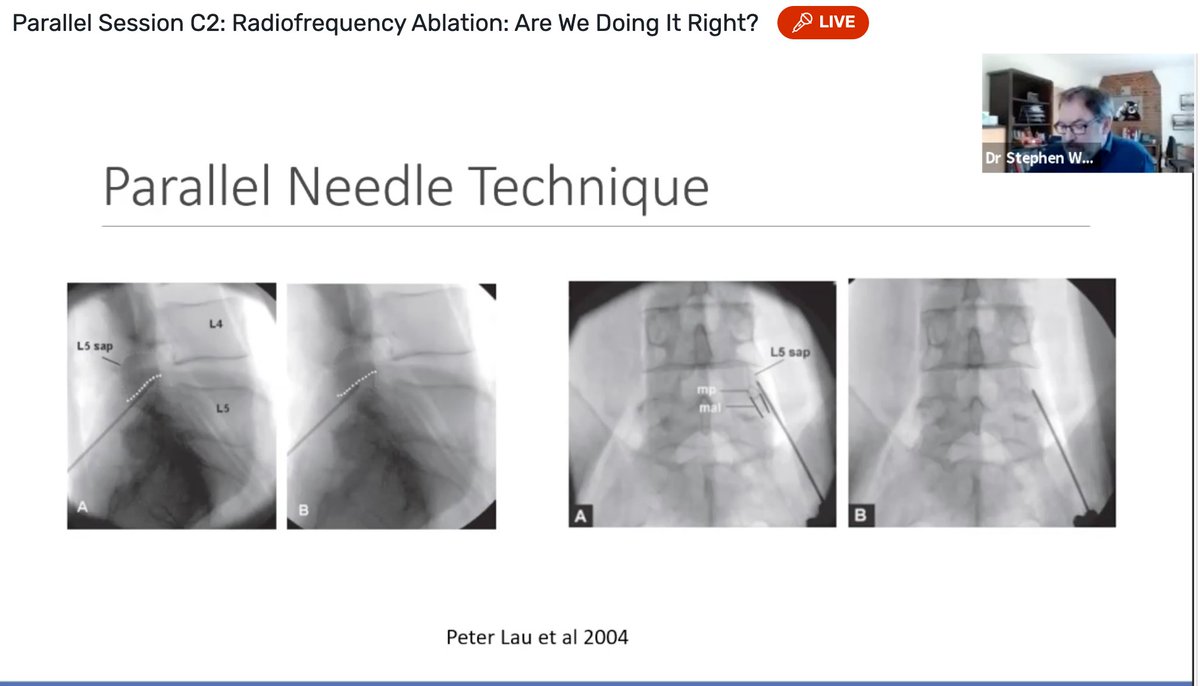 draleiva's tweet image. Radiofrequency Ablation Dr S Ward showing hisliterature research on needle position, RF parameters, patient predictors, emerging techniques for lumbar RF #BPSASM2021