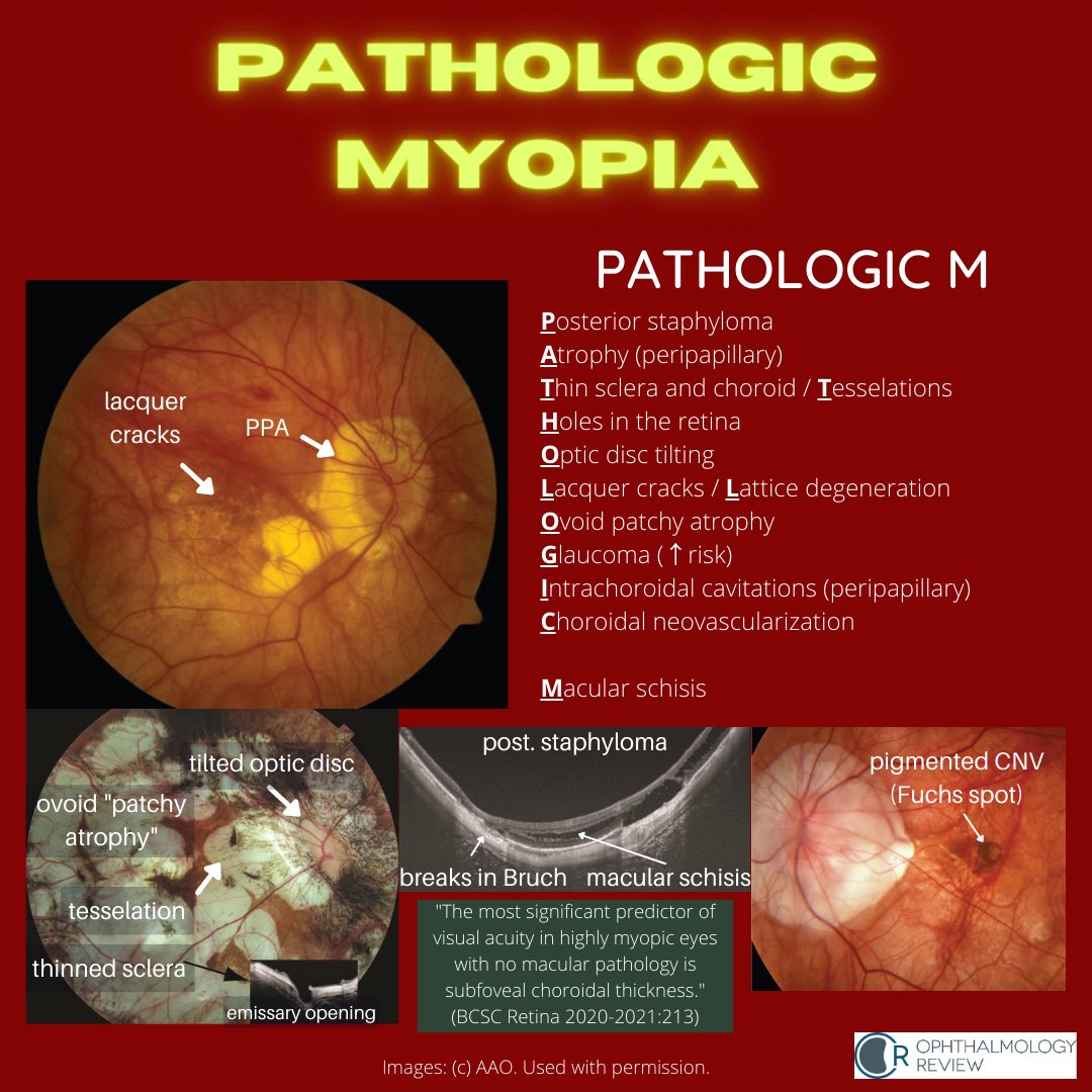 myopia and pathologic myopia injekciók vitaminok a látáshoz