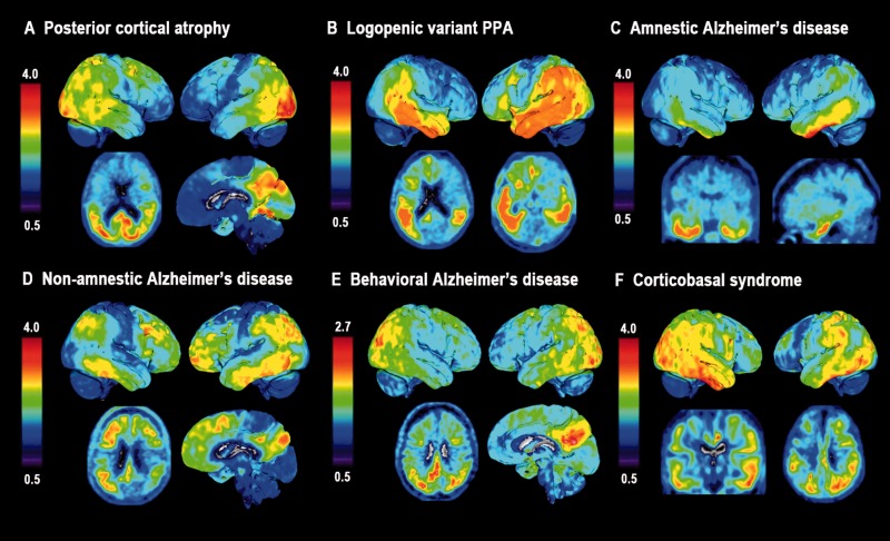  @DrNeuroChic showed limbic-predominant and hippocampal-sparing patterns that deviated from the Break progression were not uncommon  https://tinyurl.com/msts2011 .  @RikOssenkoppele showed that clinical variants of AD also have deviant patterns  https://tinyurl.com/rik2016 . What gives? 3/
