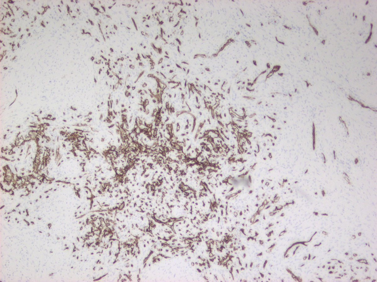 #hemepath #spleen this is a CD34 stain of an entity I propose called "medusoid nodular hemangioma" of spleen. Seen a handful of these - they look like SANT, but have this finding