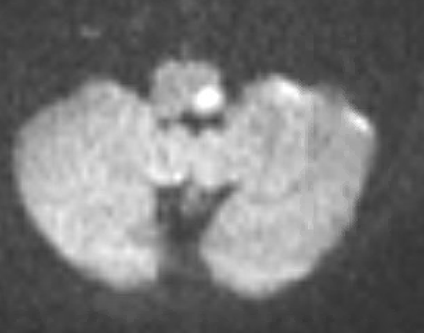 9/Thought Wallenberg? Correct!MRI revealed a sizable lateral medullary infarct and her syndrome is a partial Wallenberg syndrome.Image