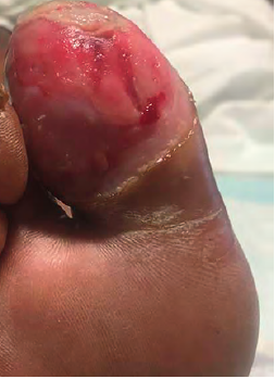 xsurgeon3's tweet photo. #DMfoot  Factors that raise the suspicion for the presence of osteomyelitis include an ulcer greater than 2 cm2 or 3 mm deep, the presence of a “sausage toe,” an erythrocyte sedimentation rate greater than 70 mm/hr. #currentsurgicaltherapybook @efsthsurgery https://t.co/ix4IMBu3Mc