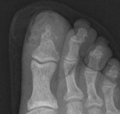xsurgeon3's tweet photo. #DMfoot  Factors that raise the suspicion for the presence of osteomyelitis include an ulcer greater than 2 cm2 or 3 mm deep, the presence of a “sausage toe,” an erythrocyte sedimentation rate greater than 70 mm/hr. #currentsurgicaltherapybook @efsthsurgery https://t.co/ix4IMBu3Mc