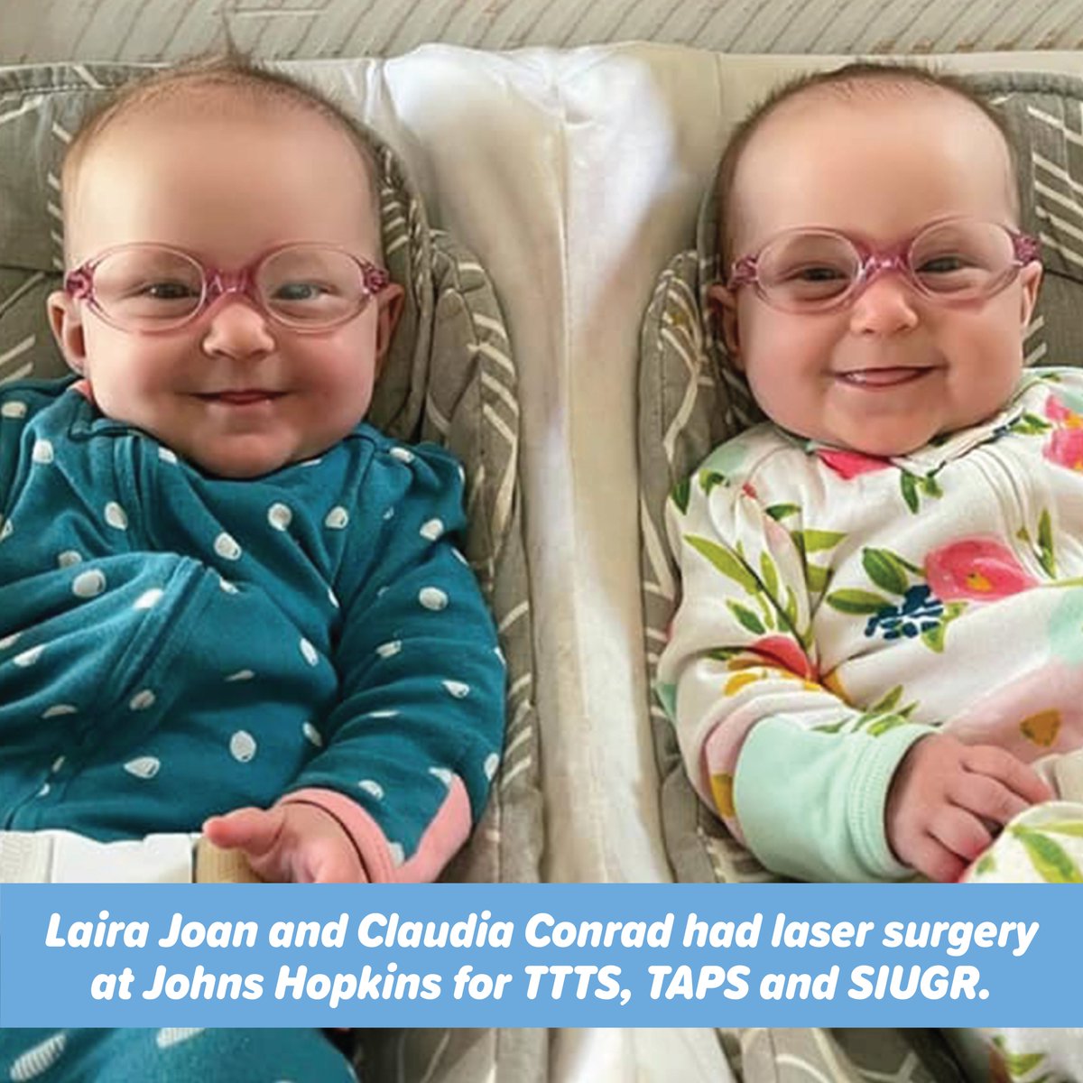 #tttsfoundation Medical Advisory Board Member Dr. Ahmet Baschat works with tttsfoundation.org to save #twins #triplets! #Monoamniotic #Monochorionic twins Laira Joan and Claudia Conrad survive #TTTS #SIUGR #twinanemiapolycythemiasequence after surgery with @drjenamiller!