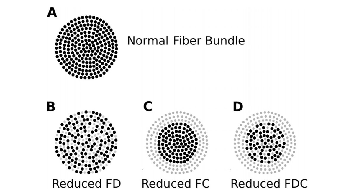 SfN Journals (@sfnjournals) on Twitter photo New #JNeurosci research from <a href="/ElouiseKoops/">Elouise A Koops</a> et al. <a href="/univgroningen/">University of Groningen</a> identifies the distinct effects of age, hearing loss & additional tinnitus on the axonal density and macrostructural morphology of the acoustic radiation, the largest central auditory tract.
jneurosci.org/lookup/DOI/10.… New #JNeurosci research from <a href="/ElouiseKoops/">Elouise A Koops</a> et al. <a href="/univgroningen/">University of Groningen</a> identifies the distinct effects of age, hearing loss & additional tinnitus on the axonal density and macrostructural morphology of the acoustic radiation, the largest central auditory tract.
jneurosci.org/lookup/DOI/10.…